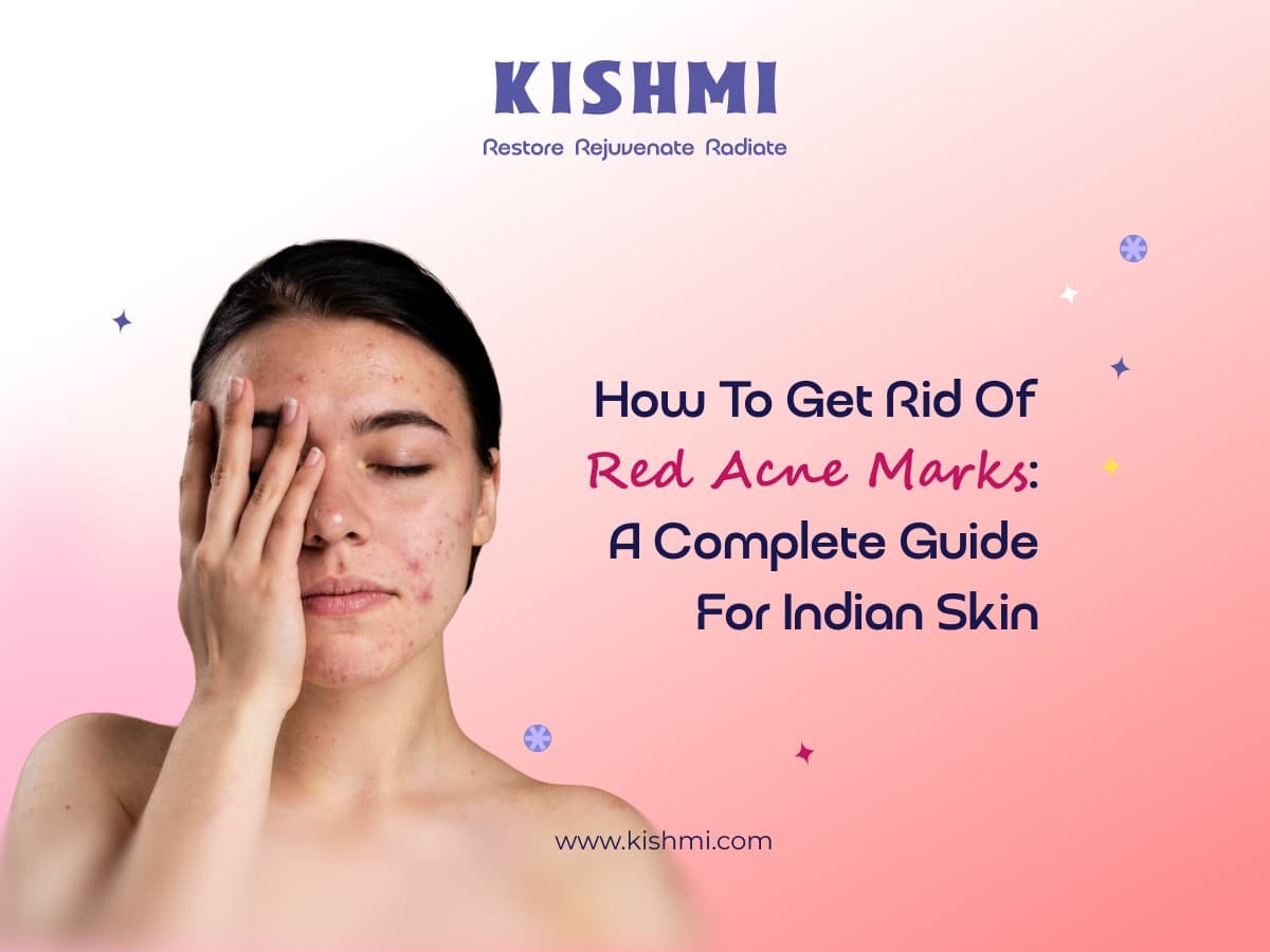 How to Get Rid of Acne Marks: A Complete Guide .