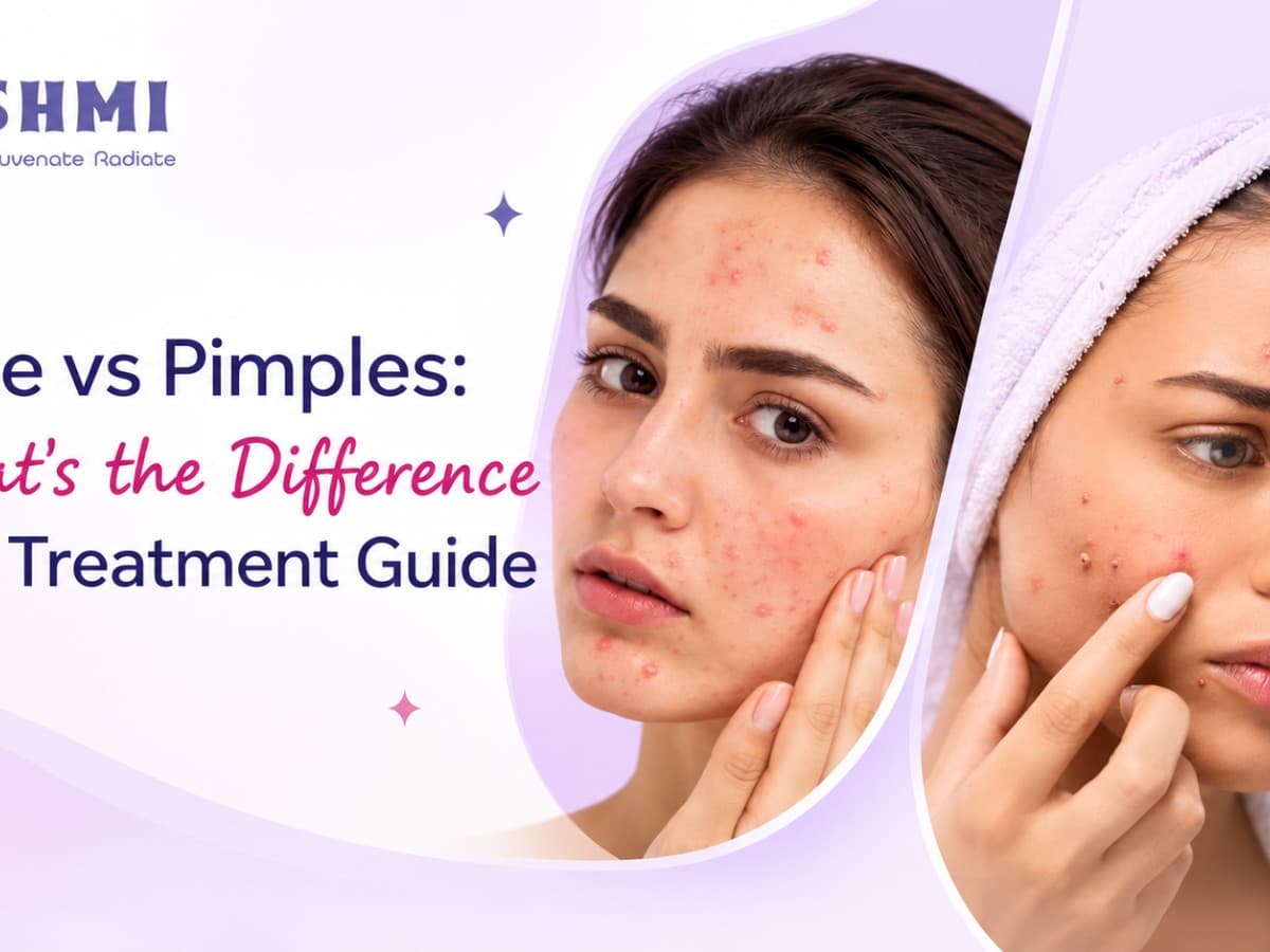 Acne vs Pimples: What's the Difference and Treatment Guide — image 1